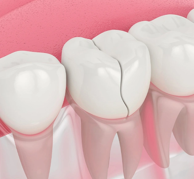 Three dental implants with white crowns illustrated against pink background, depicting tooth replacement.