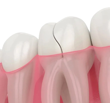 Dental illustration showing tooth cross-section with gum tissue and internal root structure detail.