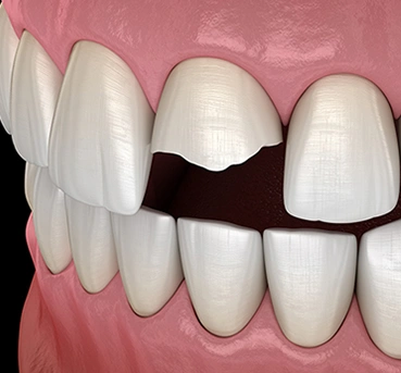 Dental crown and bridge prosthetic model showing tooth restoration on pink gum base