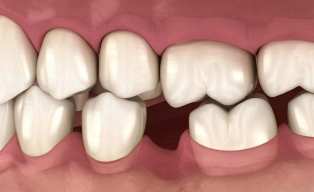 Dental illustration showing missing tooth gap between upper front teeth with pink gum tissue.